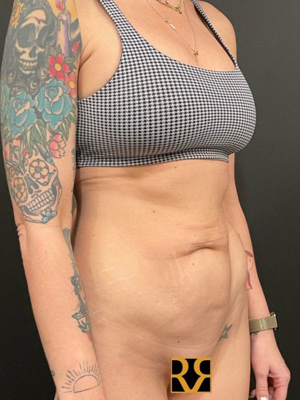 Tummy Tuck Before & After Gallery - Patient 352571 - Image 3