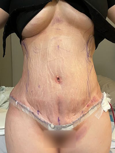 Tummy Tuck Before & After Gallery - Patient 123022 - Image 2