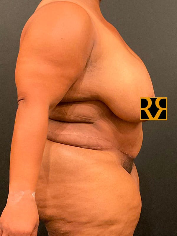 Plus Size Tummy Tuck® Before & After Gallery - Patient 172702292 - Image 4