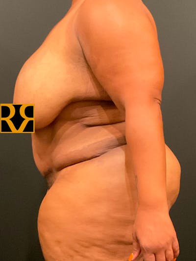 Plus Size Tummy Tuck® Before & After Gallery - Patient 172702292 - Image 6