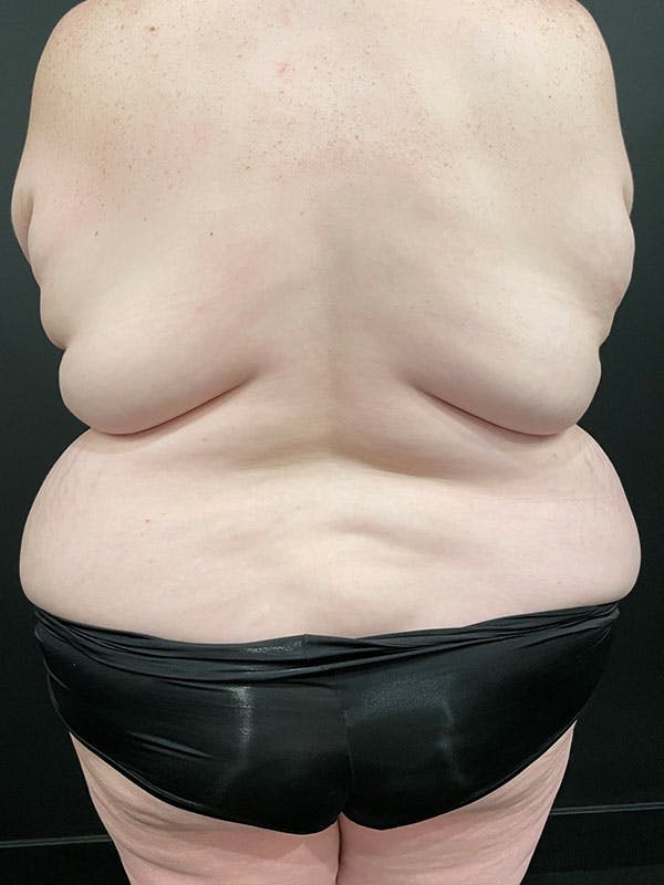 Plus Size Tummy Tuck® Before & After Gallery - Patient 389108 - Image 5