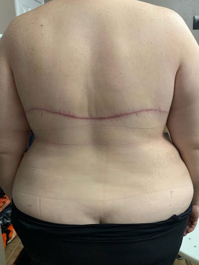 Plus Size Tummy Tuck® Before & After Gallery - Patient 389108 - Image 6
