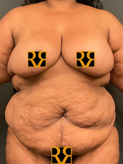 Plus Size Tummy Tuck® Before & After Gallery - Patient 203216 - Image 1