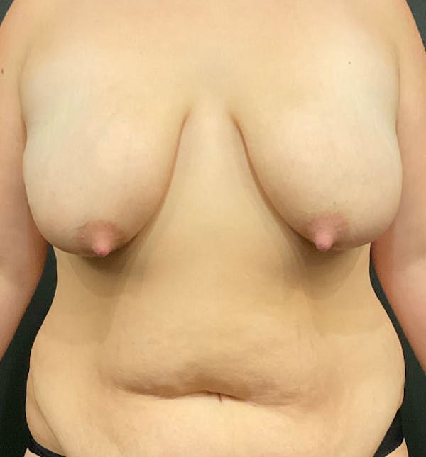 Breast Lift Mastopexy Before & After Gallery - Patient 425510 - Image 1
