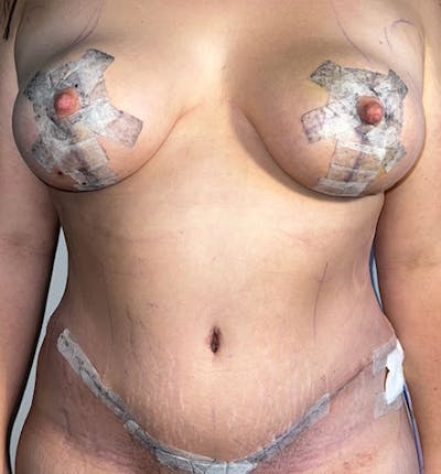Breast Lift Mastopexy Before & After Gallery - Patient 425510 - Image 2