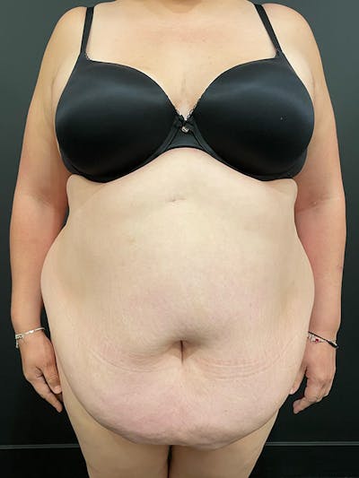 Plus Size Tummy Tuck Surgery Before & After Photo Gallery - Patient #47