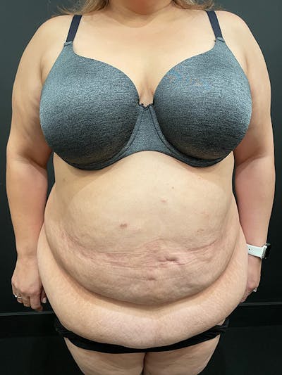 Plus Size Tummy Tuck® Before & After Gallery - Patient 100990 - Image 1