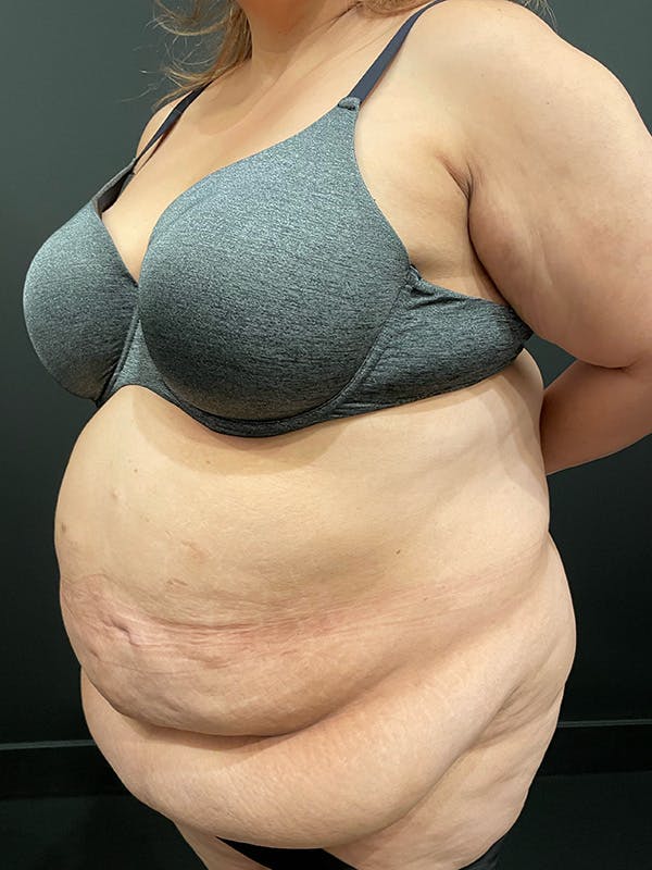 Plus Size Tummy Tuck® Before & After Gallery - Patient 100990 - Image 3