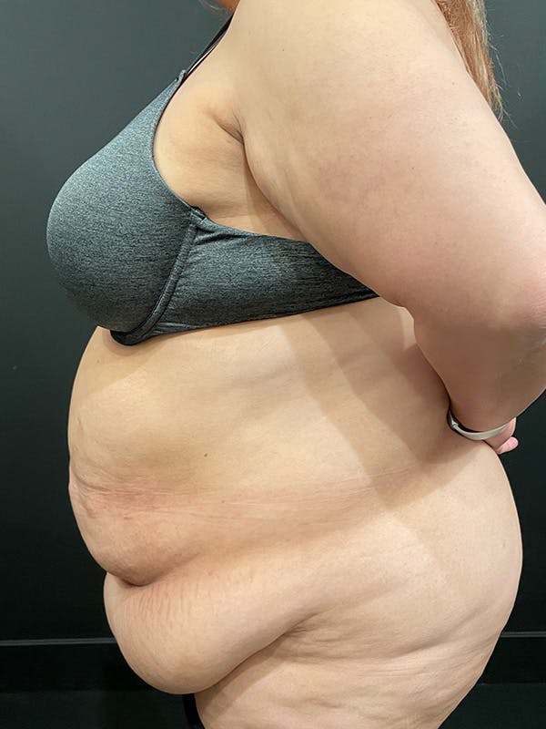 Plus Size Tummy Tuck® Before & After Gallery - Patient 100990 - Image 5