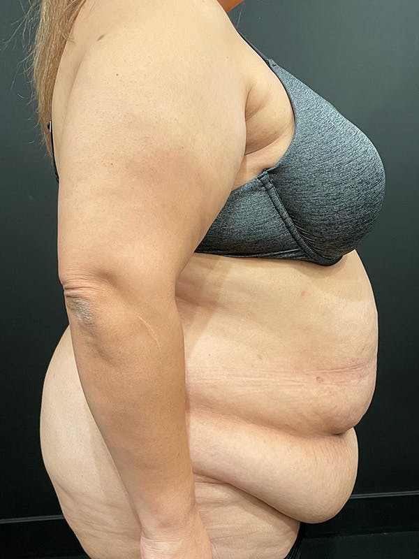 Plus Size Tummy Tuck® Before & After Gallery - Patient 100990 - Image 7