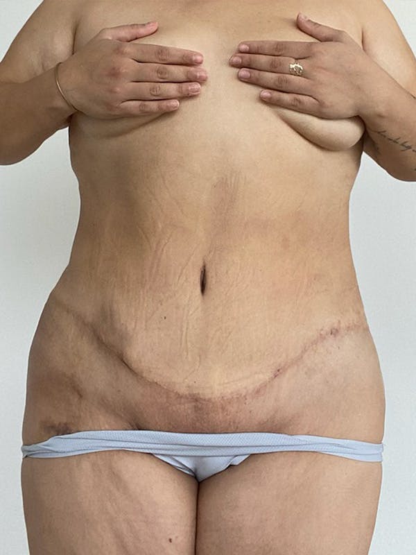 Plus Size Tummy Tuck® Before & After Gallery - Patient 603352 - Image 2