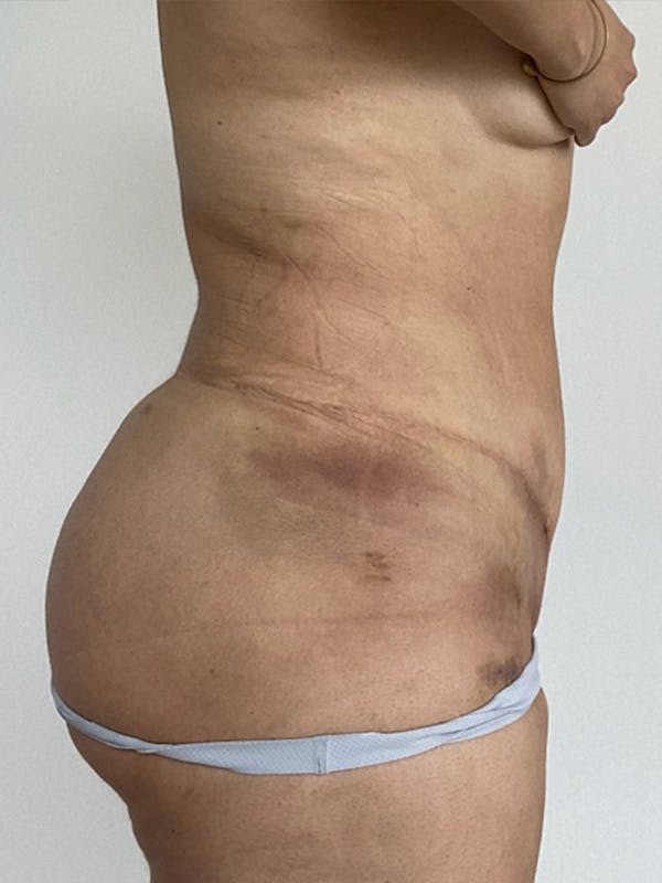 Plus Size Tummy Tuck® Before & After Gallery - Patient 603352 - Image 4