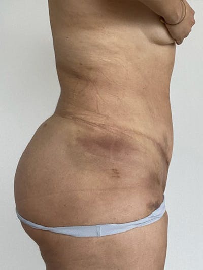 Plus Size Tummy Tuck® Before & After Gallery - Patient 603352 - Image 4