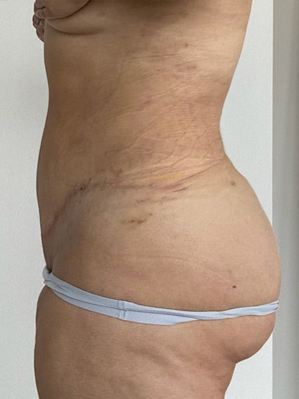 Plus Size Tummy Tuck® Before & After Gallery - Patient 603352 - Image 6