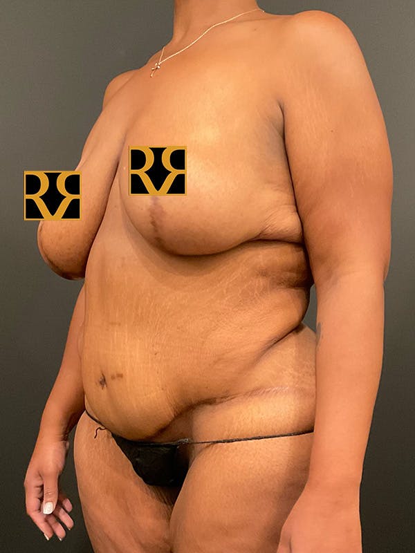 Tummy Tuck Before & After Gallery - Patient 135473 - Image 3