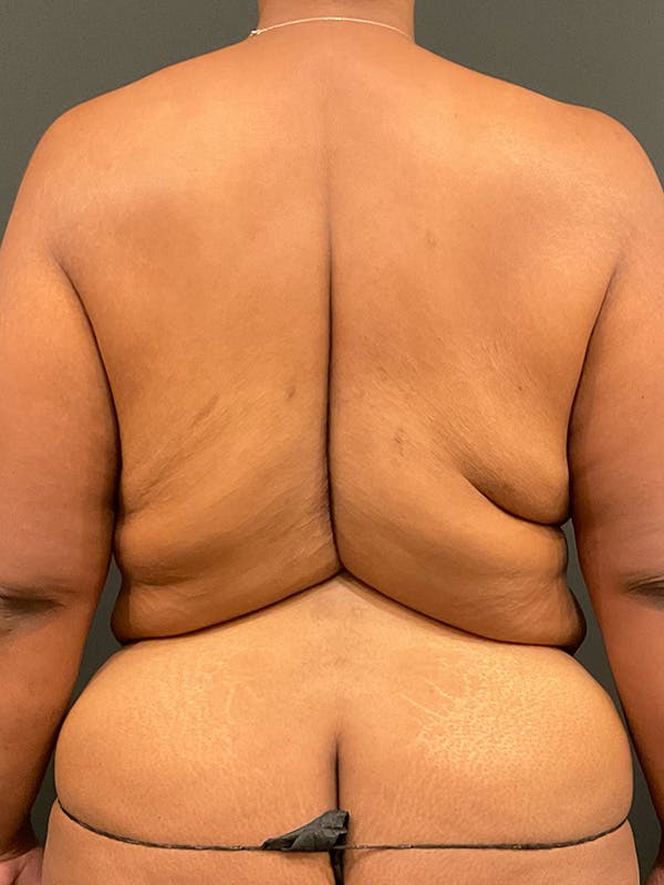 Tummy Tuck Before & After Gallery - Patient 135473 - Image 9