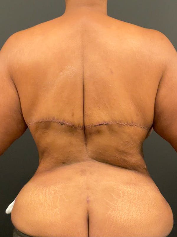 Tummy Tuck Before & After Gallery - Patient 135473 - Image 10
