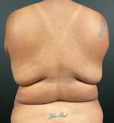 Bra Line Back Lift Before & After Photos Patient 1154, Serving Rochester,  Syracuse & Buffalo, NY