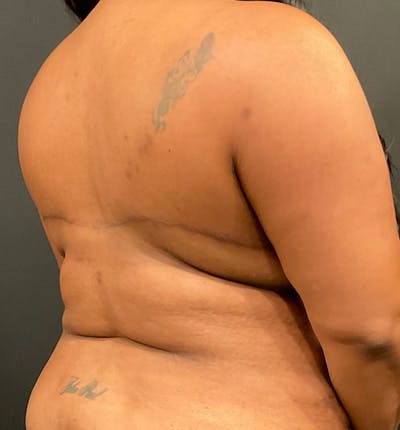 Bra Line Back Lift™ Before & After Gallery - Patient 287666 - Image 6