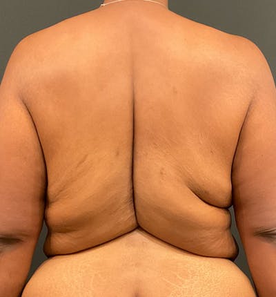 Patient #17574 Bra Line Lift Before and After Photos Pittsburgh