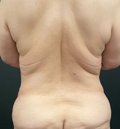 Bra Line Back Lift™ Before & After Gallery - Patient 299204 - Image 1