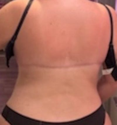 Bra Line Back Lift™ Before & After Gallery - Patient 218277 - Image 2