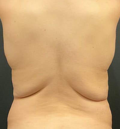 Bra Line Back Lift™ Before & After Gallery - Patient 151383 - Image 1