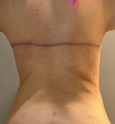 Bra Line Back Lift™ Before & After Gallery - Patient 151383 - Image 2