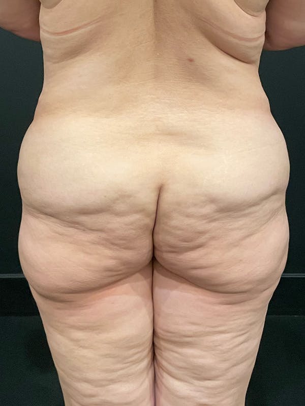 Buttock Shaping Before & After Gallery - Patient 162592 - Image 1