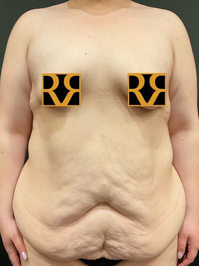 Plus Size Tummy Tuck: Day After Surgery Before & After Gallery - Patient 397226 - Image 1