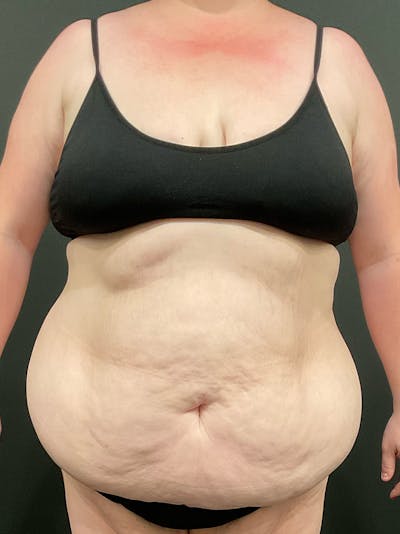 Plus Size Tummy Tuck: Week After Surgery Before & After Gallery - Patient 148383 - Image 1