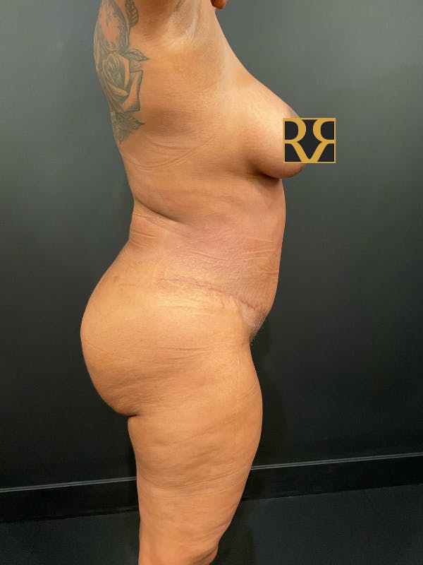 Tummy Tuck Before & After Gallery - Patient 123744635 - Image 6
