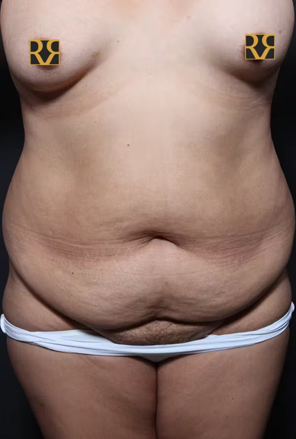 Tummy Tuck Before & After Gallery - Patient 20543233 - Image 1