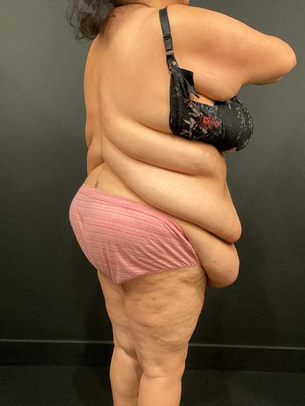 Plus Size Tummy Tuck® Before & After Gallery - Patient 144282 - Image 9