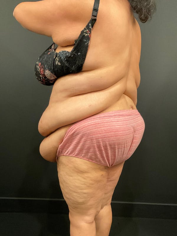 Plus Size Tummy Tuck® Before & After Gallery - Patient 144282 - Image 7