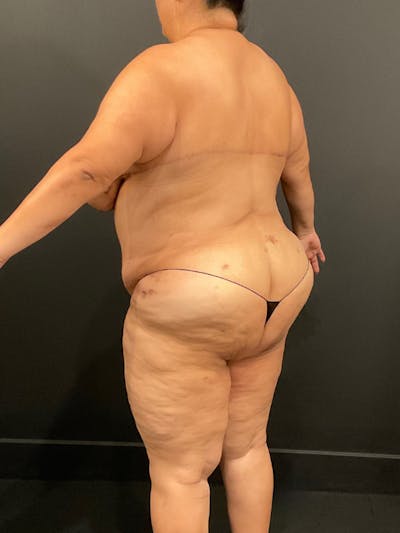 Plus Size Tummy Tuck® Before & After Gallery - Patient 144282 - Image 8
