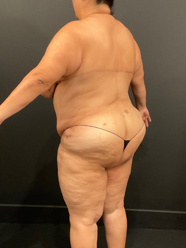 Plus Size Tummy Tuck® Before & After Gallery - Patient 144282 - Image 8