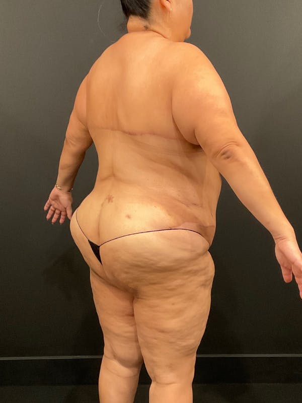Plus Size Tummy Tuck® Before & After Gallery - Patient 144282 - Image 10
