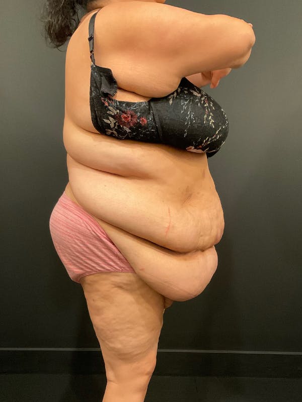 Plus Size Tummy Tuck® Before & After Gallery - Patient 144282 - Image 5