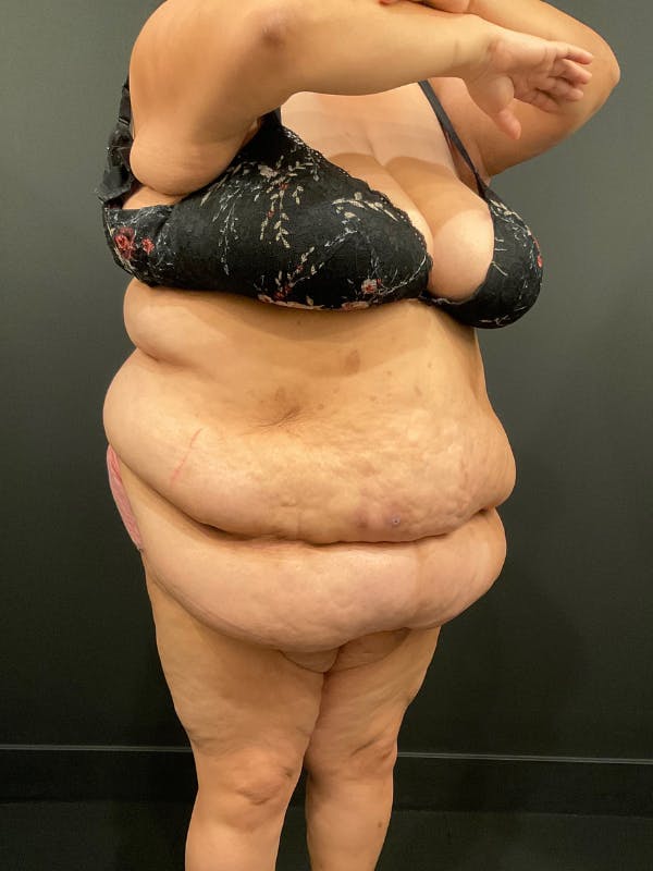 Plus Size Tummy Tuck® Before & After Gallery - Patient 144282 - Image 3