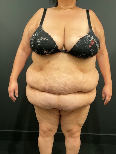 Plus Size Tummy Tuck® Before & After Gallery - Patient 144282 - Image 1