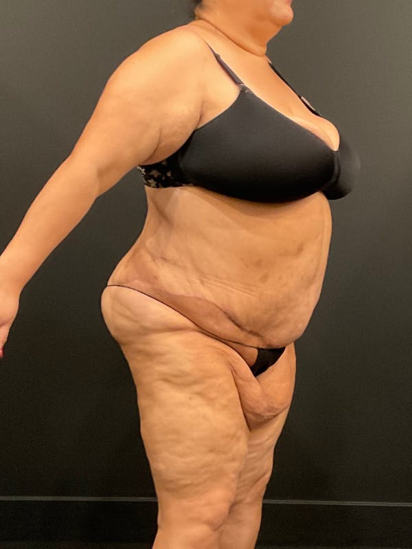 Plus Size Tummy Tuck® Before & After Gallery - Patient 144282 - Image 4