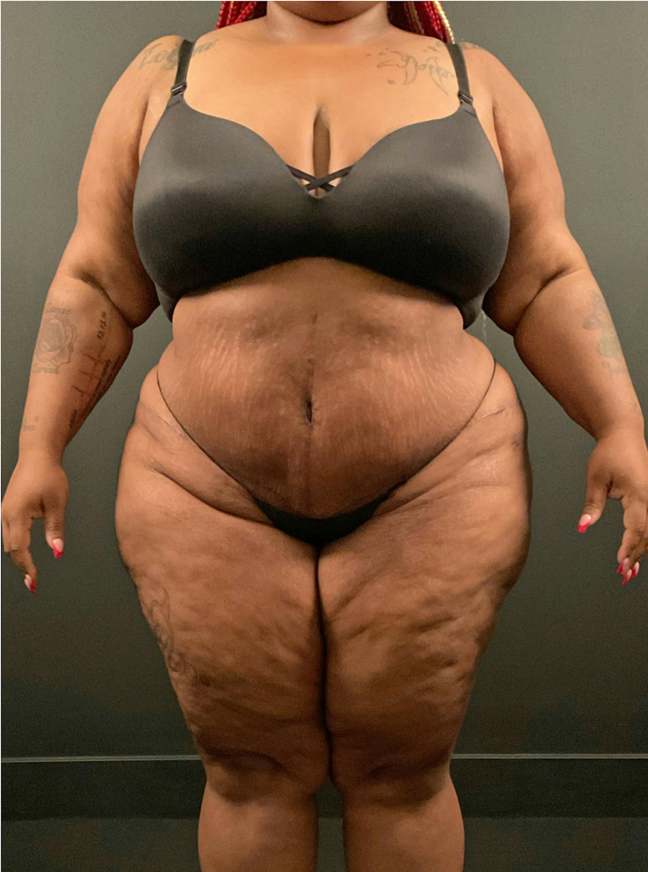 Patient A After Photo