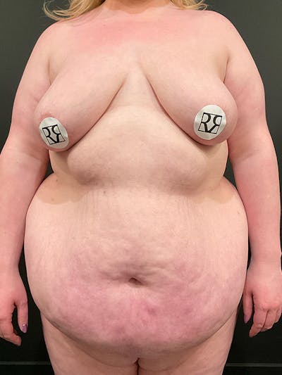 Plus Size Tummy Tuck® Before & After Gallery - Patient 822167 - Image 1