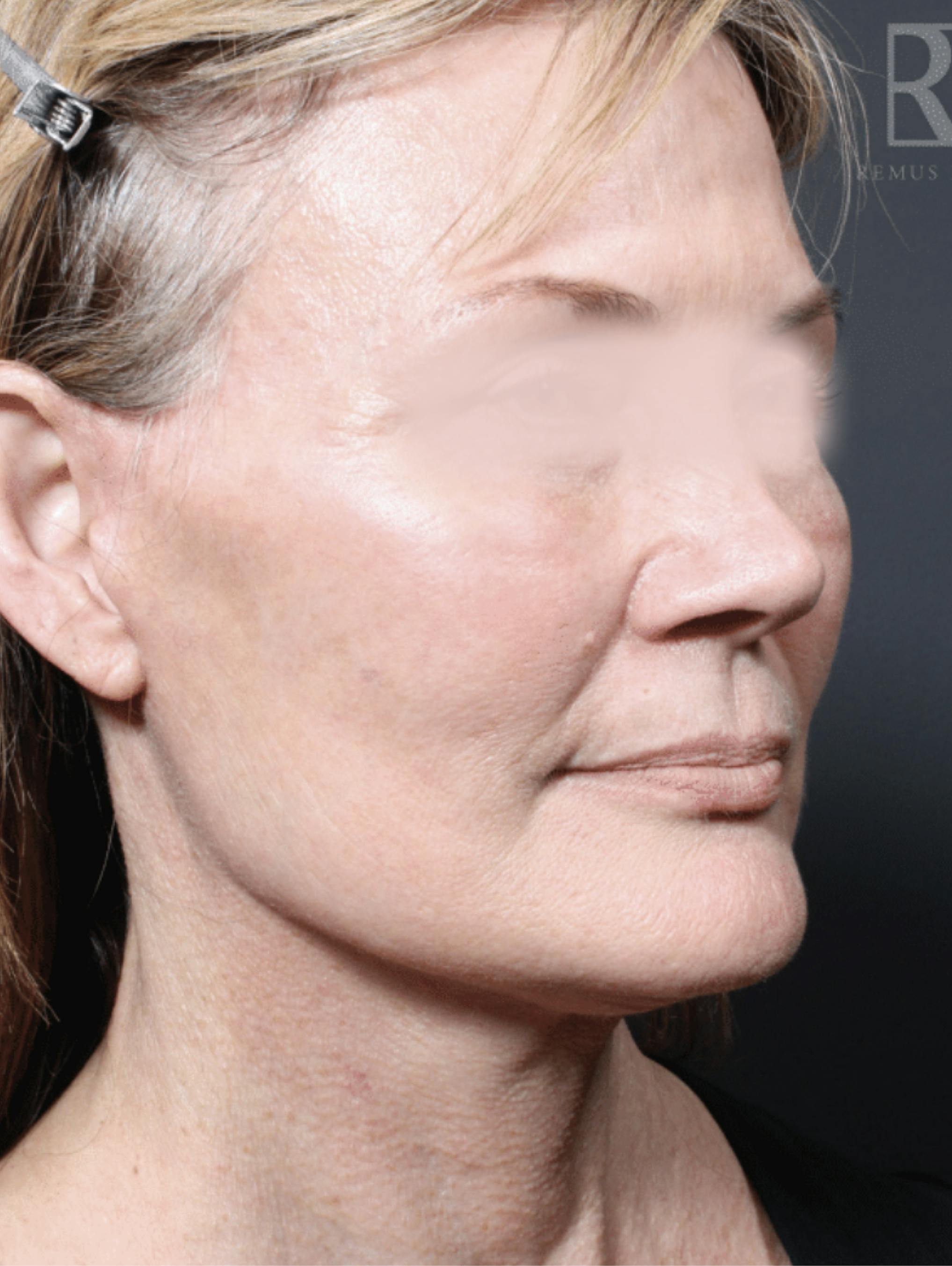 Patient B After Photo