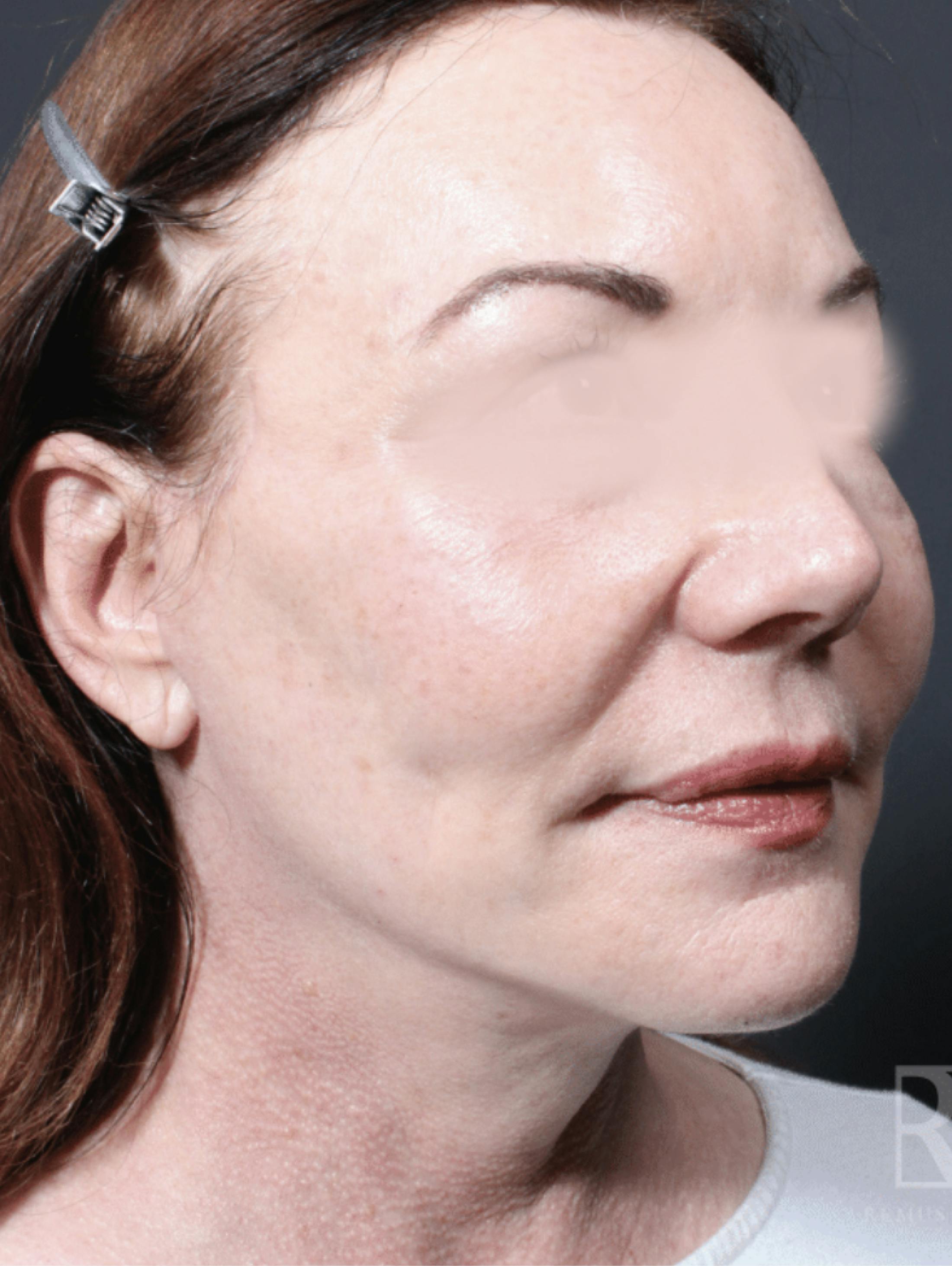 Patient A After Photo