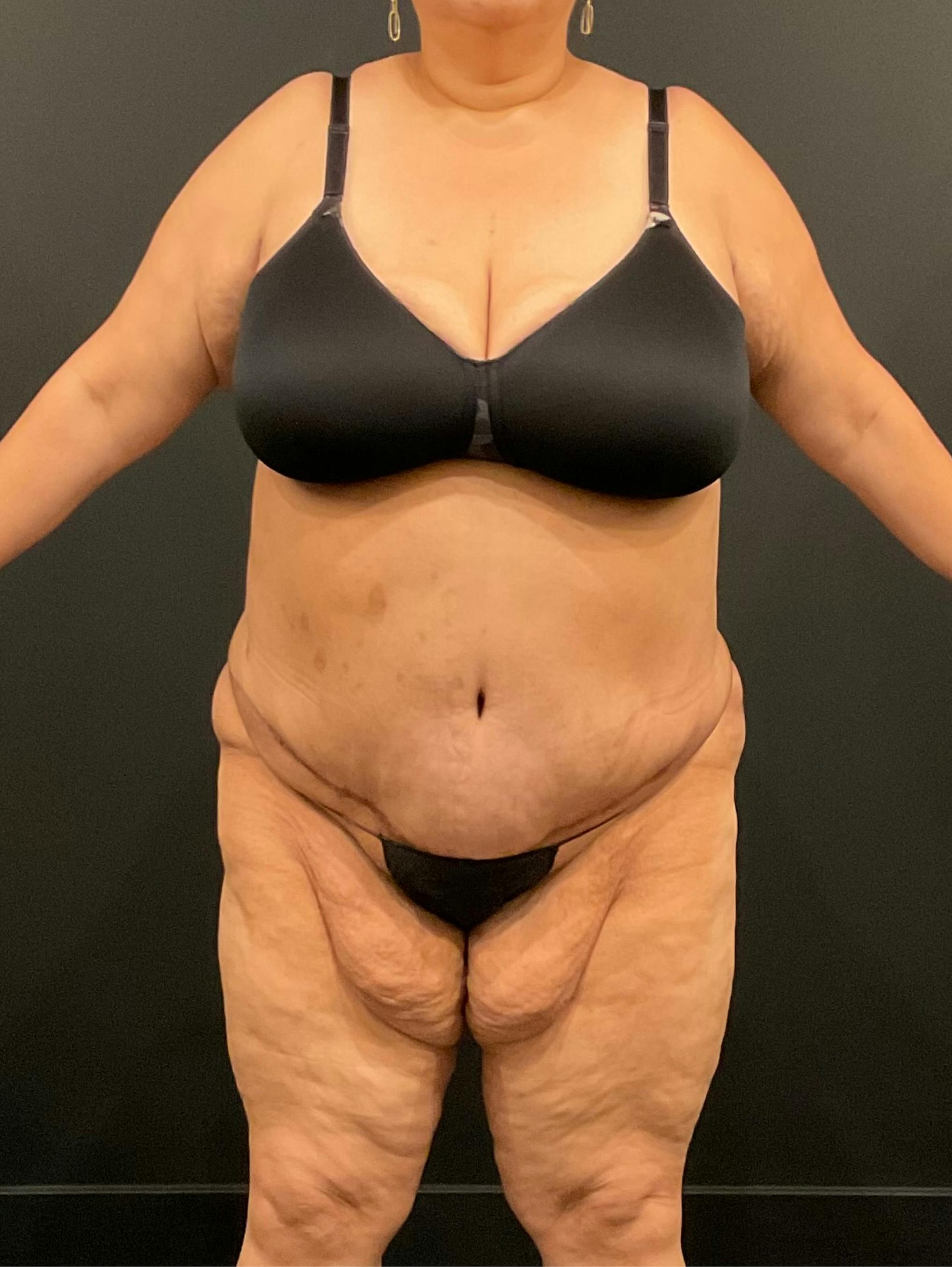 Patient D After Photo