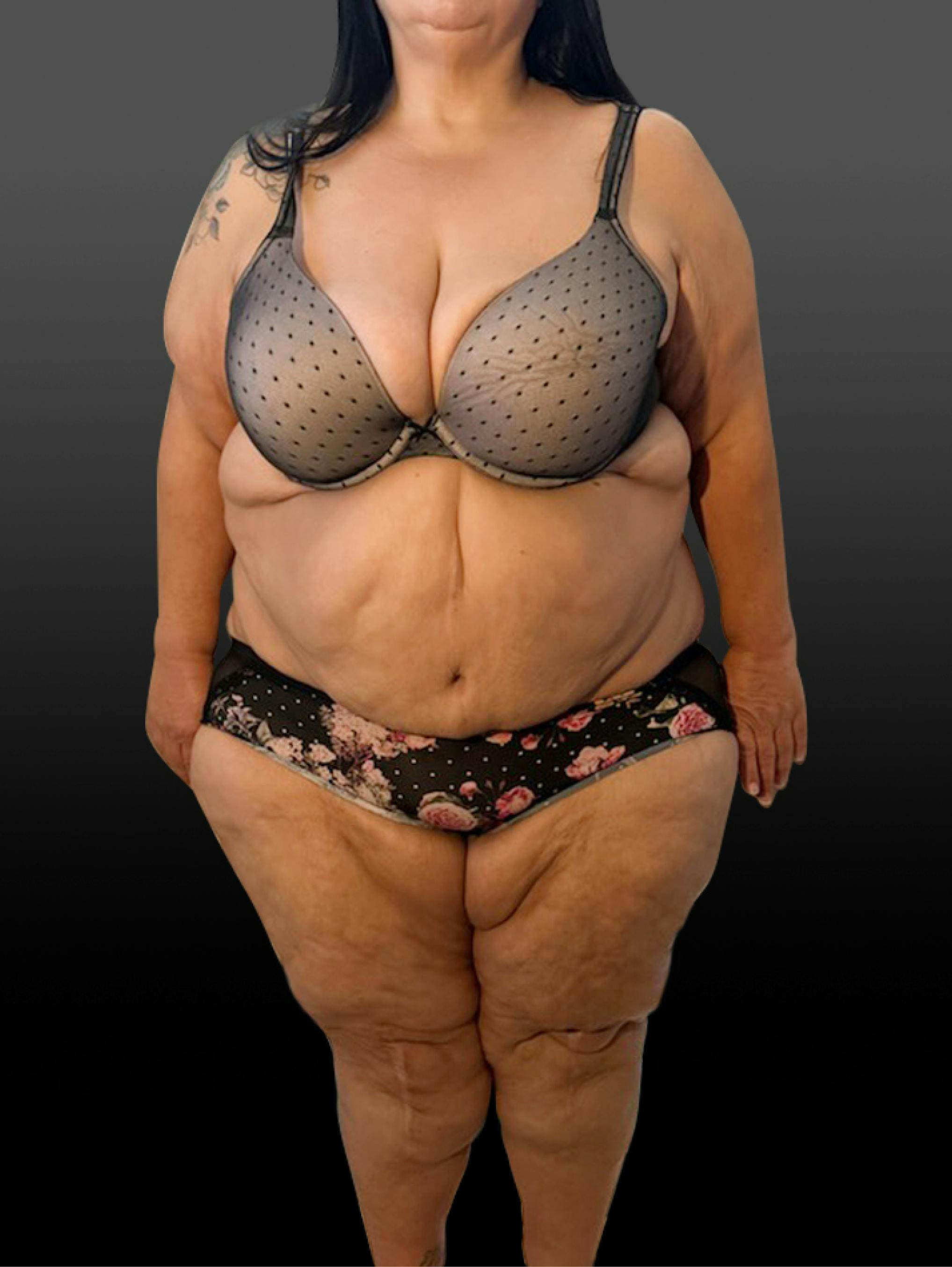 Patient E After Photo