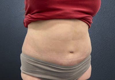 Tummy Tuck Before & After Gallery - Patient 373530 - Image 4