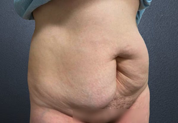 Tummy Tuck Before & After Gallery - Patient 373530 - Image 3